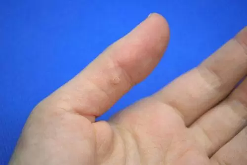 kurzajka i jej budowa