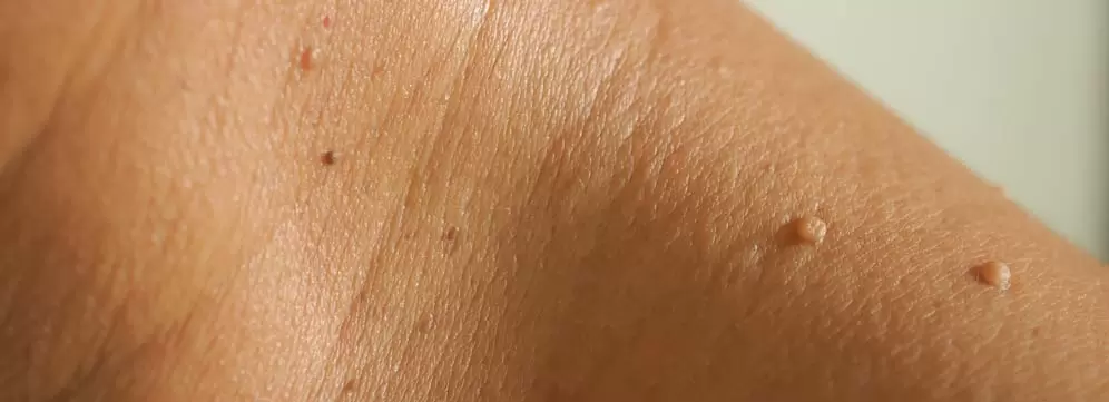 Zdjęcie włókniaków na skórze