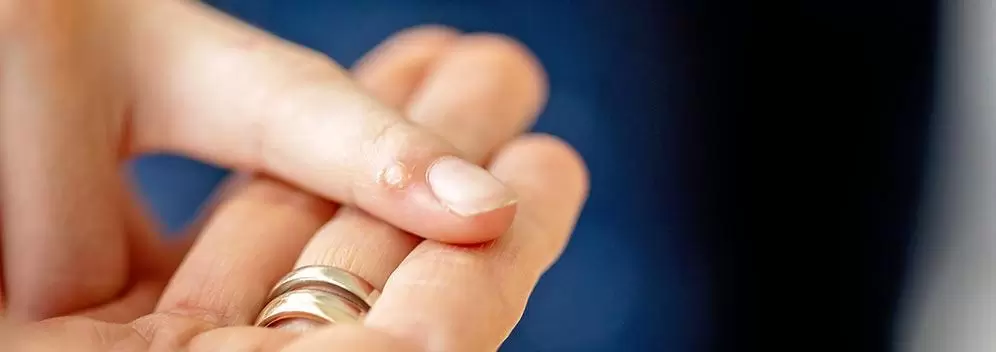 Zdjęcie kurzajki na palcu dłoni