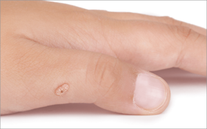 Zdjęcie kurzajki na dłoni