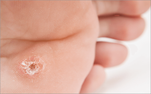 Zdjęcie kurzajki na stopie