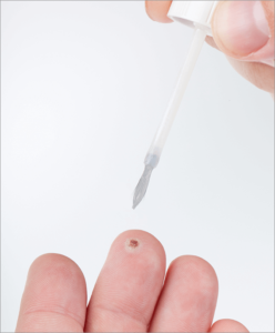 Zdjęcie zabiegu z zastosowaniem płynu Brodacid