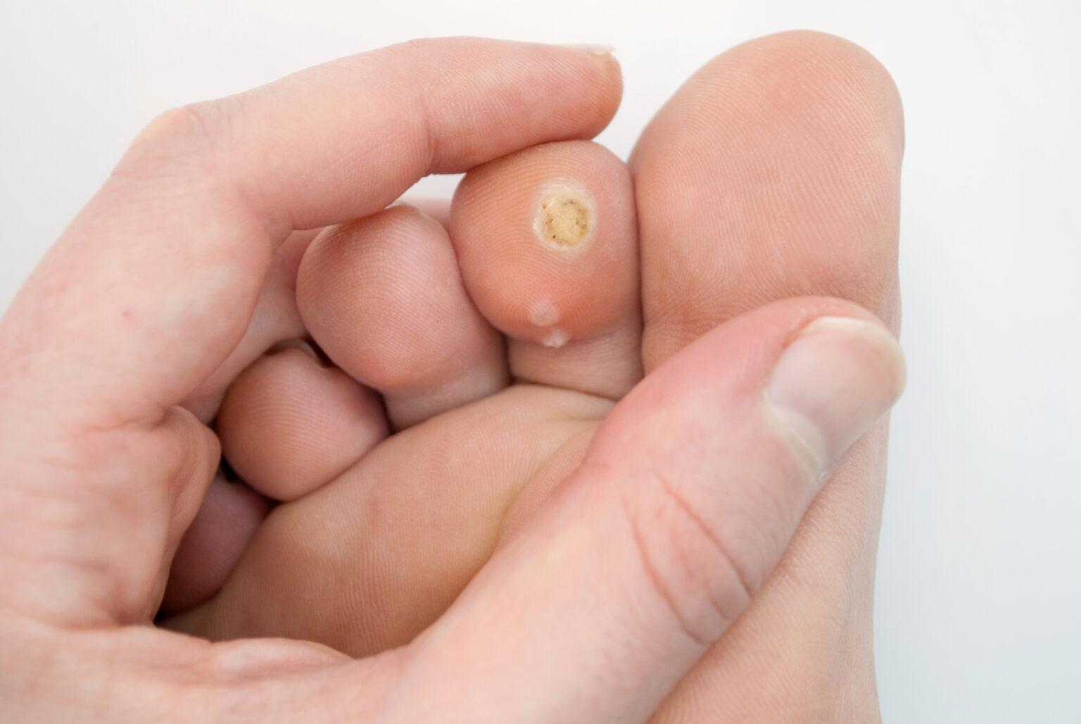 Czy nieleczone kurzajki same znikają?