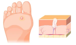 Rysunek przedstawiający wygląd kurzajki na stopie