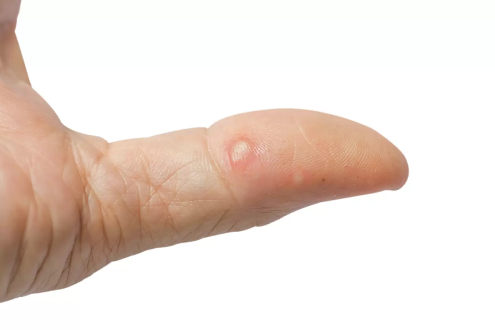 Kwas salicylowy na kurzajki jak działa