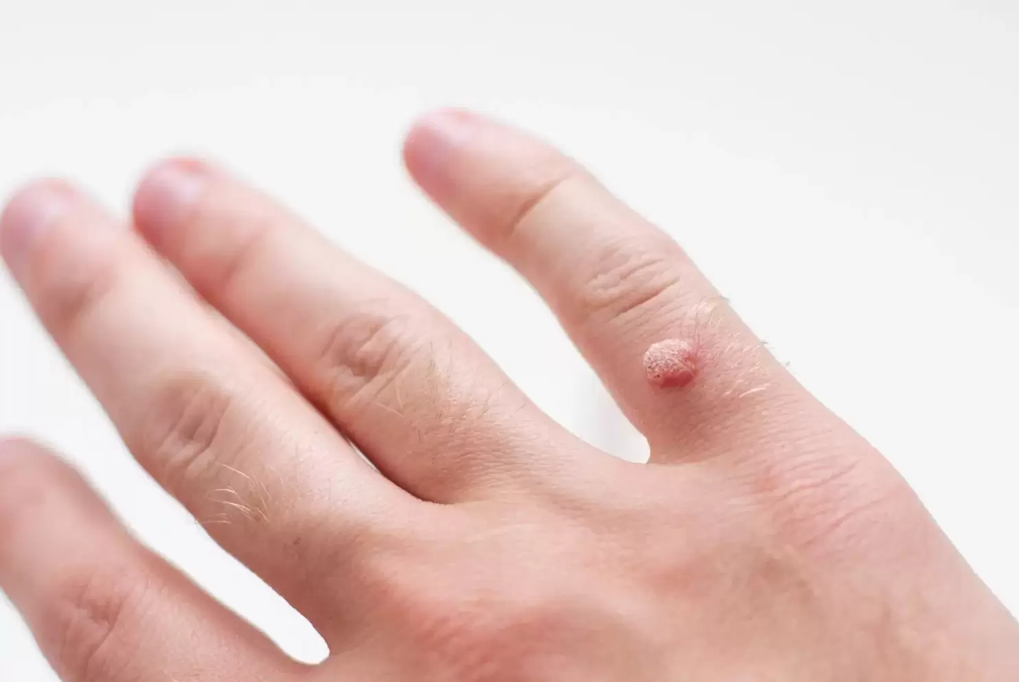 kurzajki na dłoniach